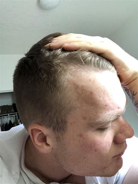 Am I balding or is it just my hairline?