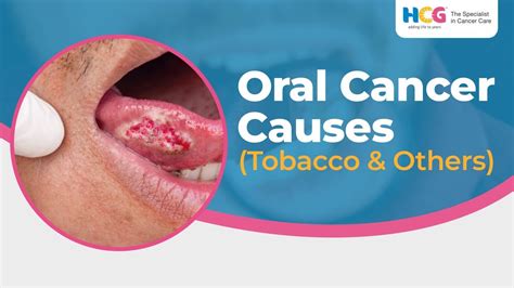 Are 90% of oral cancers caused from smoking?