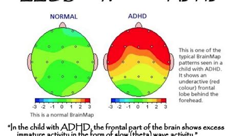 Are ADHD brains underdeveloped?