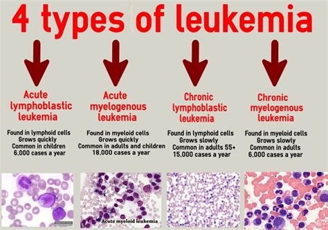 Are ALL types of leukemia fatal?