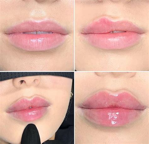 Are Russian lips more natural?