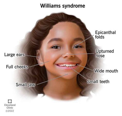 Are Williams syndrome babies small?