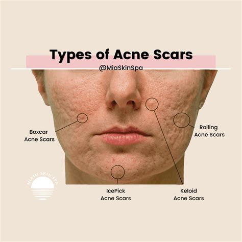 Are acne scars Perma?