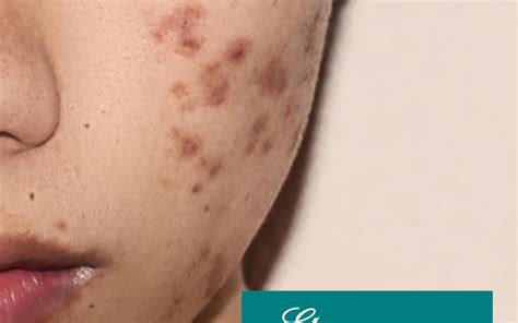 Are acne scars permanent?