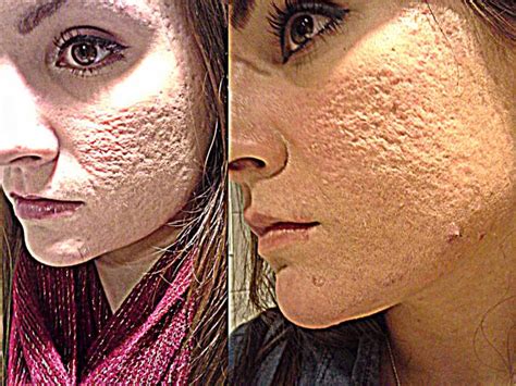 Are acne scars unattractive?