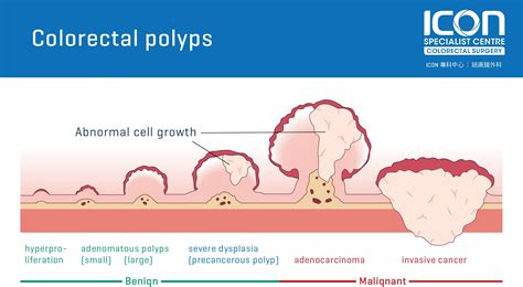 Are all large polyps cancerous?