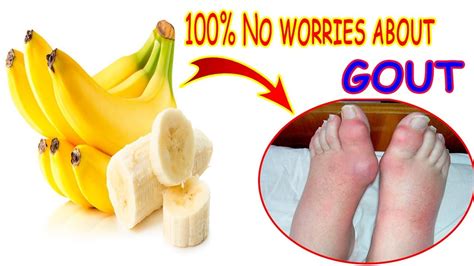 Are bananas bad for gout?