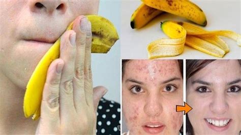 Are bananas good for acne?