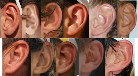 Are big ears genetic?