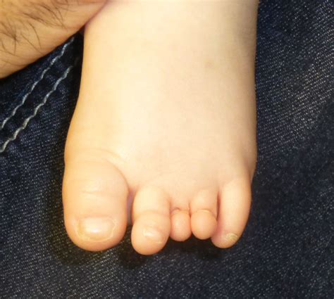 Are big feet genetic?