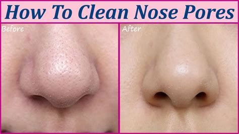 Are big nose pores normal?