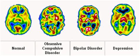 Are bipolar people smarter than average?