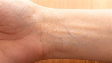 Are blue veins normal?
