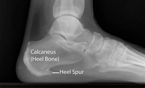 Are bone spurs hard or soft?