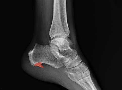 Are bone spurs in feet a disability?