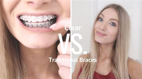 Are braces worth it?