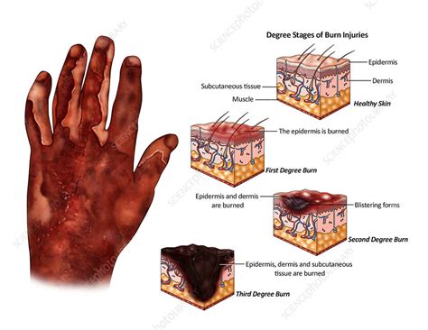 Are burns the most painful injury?