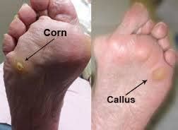Are calluses permanent?