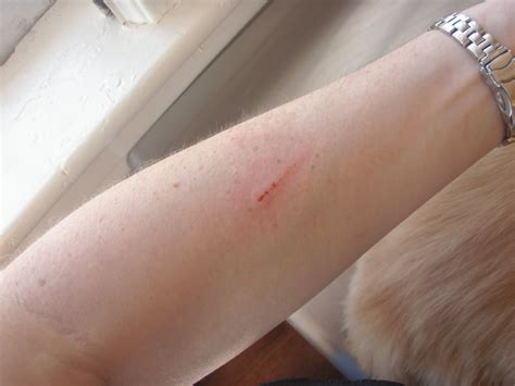 Are cat scratches worse than bites?