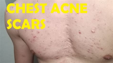 Are chest acne scars permanent?
