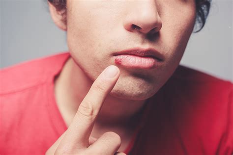 Are cold sores embarrassing?