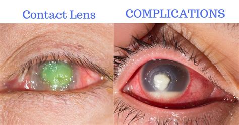 Are contacts bad for your eyes?