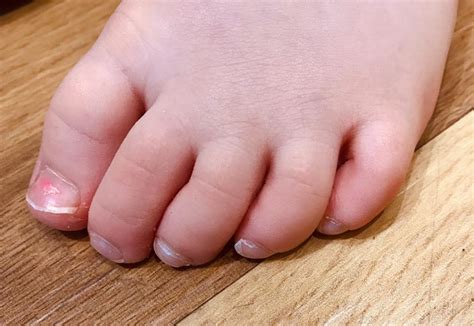 Are curly toes genetic?
