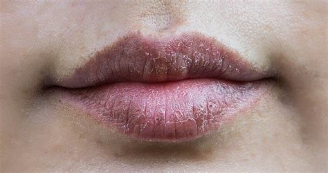 Are dark lips unhealthy?