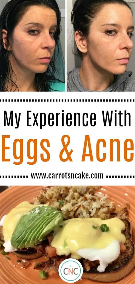 Are eggs bad for acne?