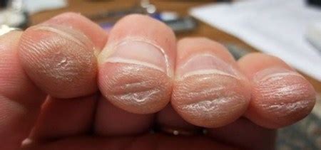Are finger calluses permanent?
