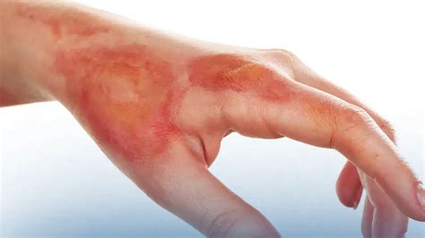 Are first-degree burns painless?