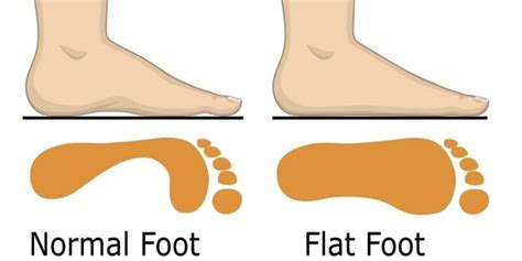 Are flat feet normal?