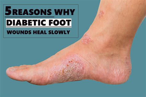 Are foot injuries slow to heal?
