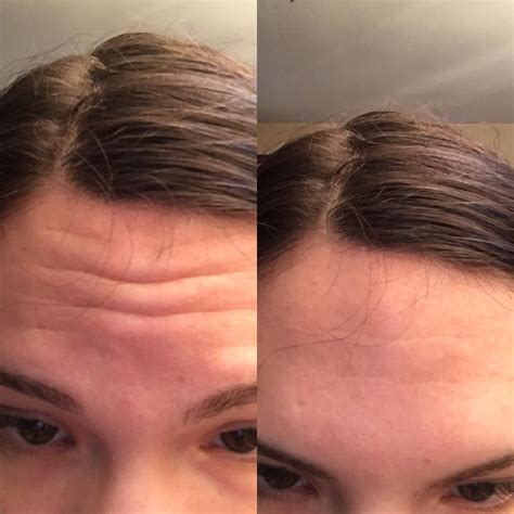 Are forehead wrinkles normal?