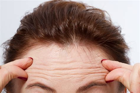Are forehead wrinkles permanent?