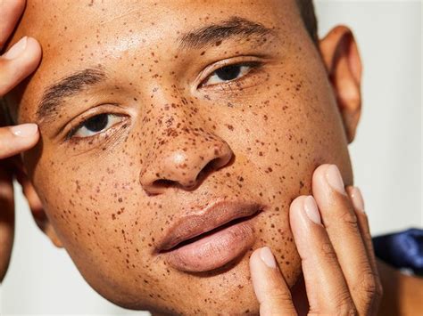 Are freckles birthmarks?
