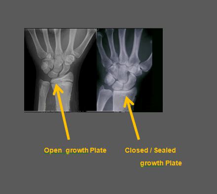 Are growth plates still open at 25?