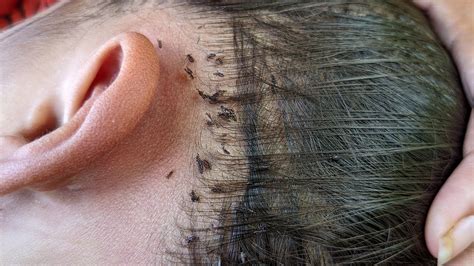 Are head lice black?