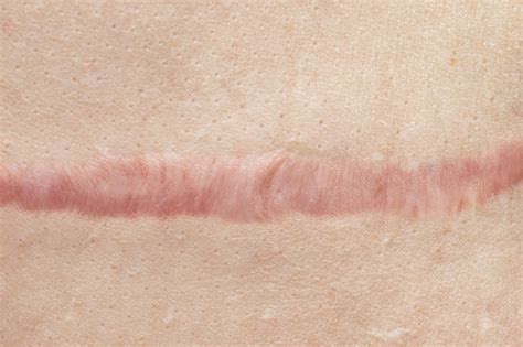 Are healed scars lighter?