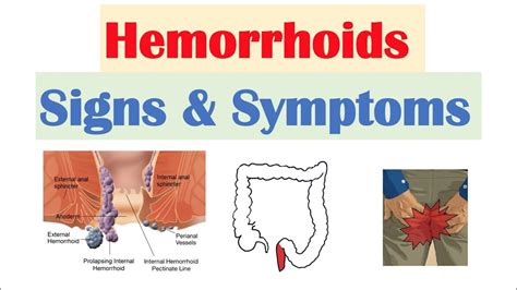 Are hemorrhoids embarrassing?