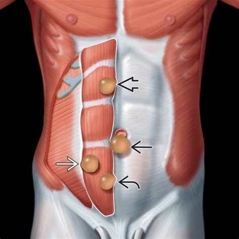 Are hernias hard or soft?