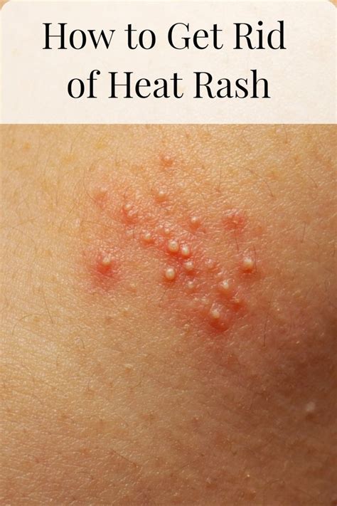 Are hot showers bad for rashes?