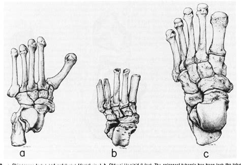 Are human feet evolving?