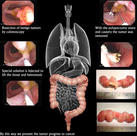 Are large colon polyps ever benign?