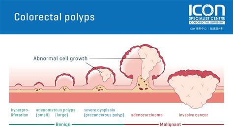 Are large polyps usually benign?