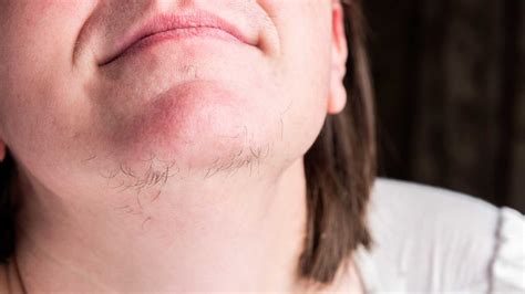 Are long chin hairs normal?