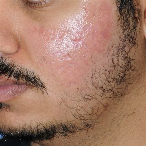 Are most acne scars permanent?