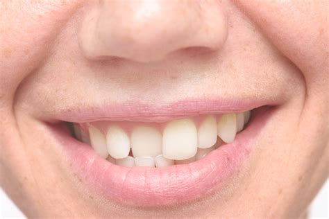 Are not straight teeth unattractive?