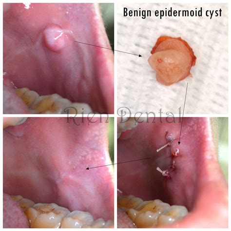 Are oral cysts hard or soft?
