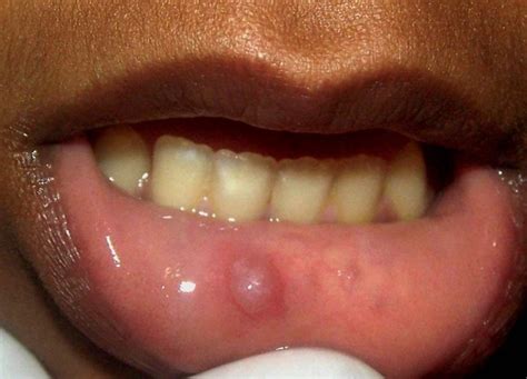 Are oral mucoceles hard?